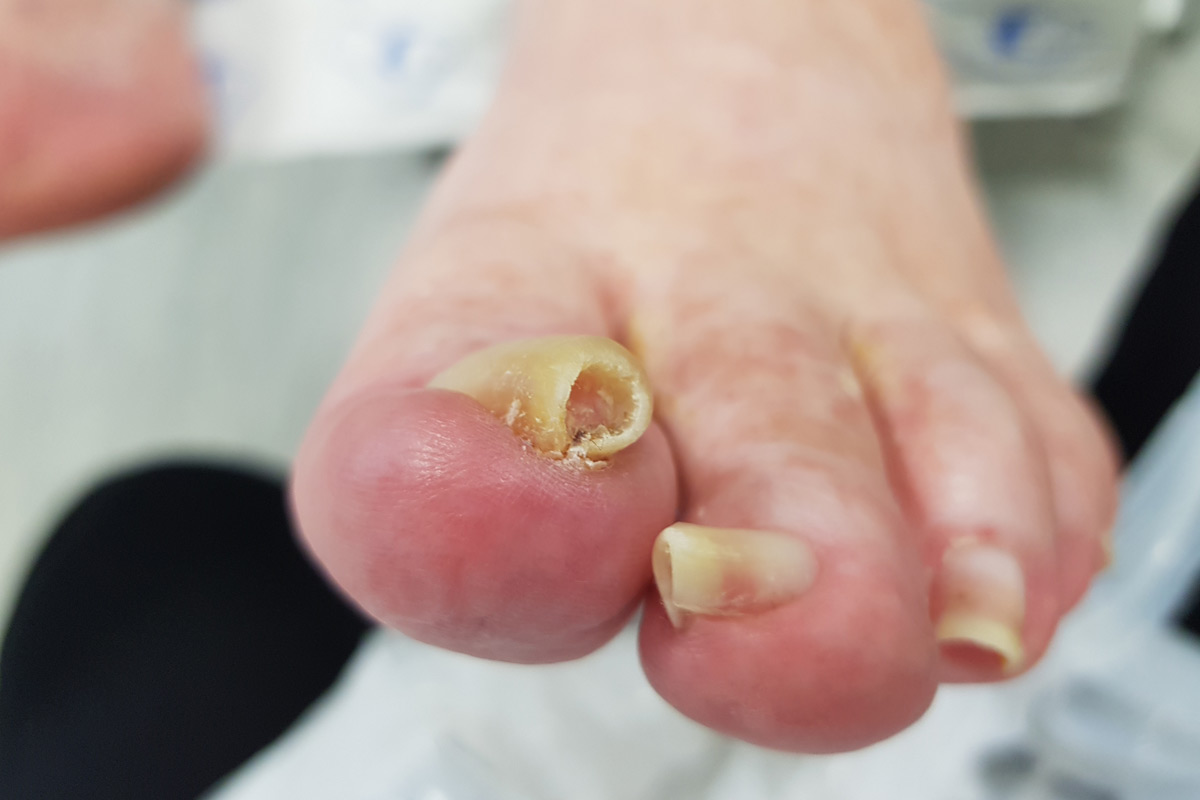 Twisted nail condition